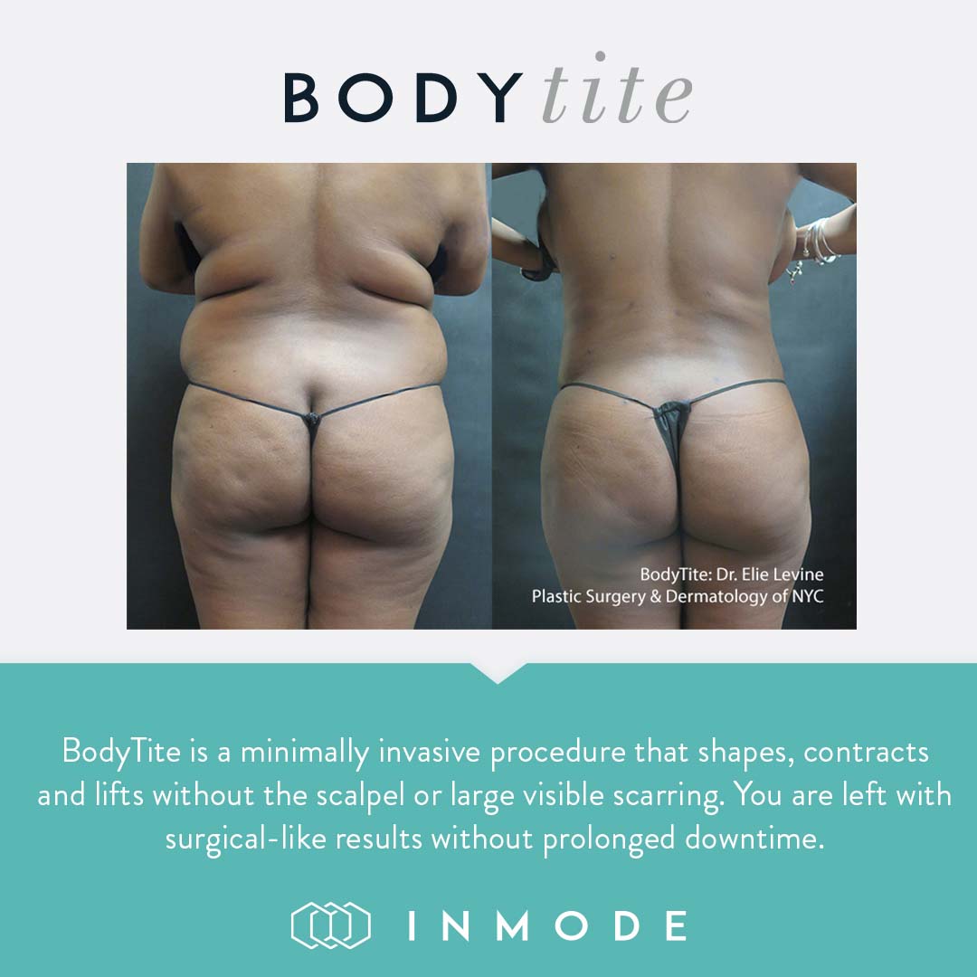 Brea Medical Aesthetics Body Tite Inmode