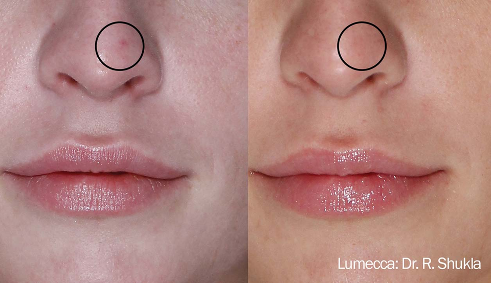 NUC Aesthetics Lumecca Dr. R. Shukla