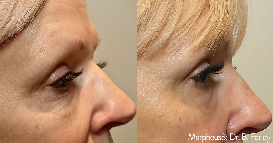 Micro Needling in Brea