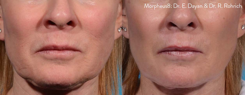 Micro Needling Near Me