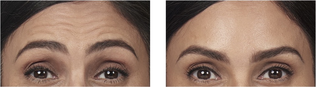 BOTOX Newport Beach