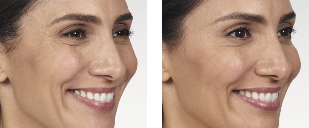 BOTOX Near Me
