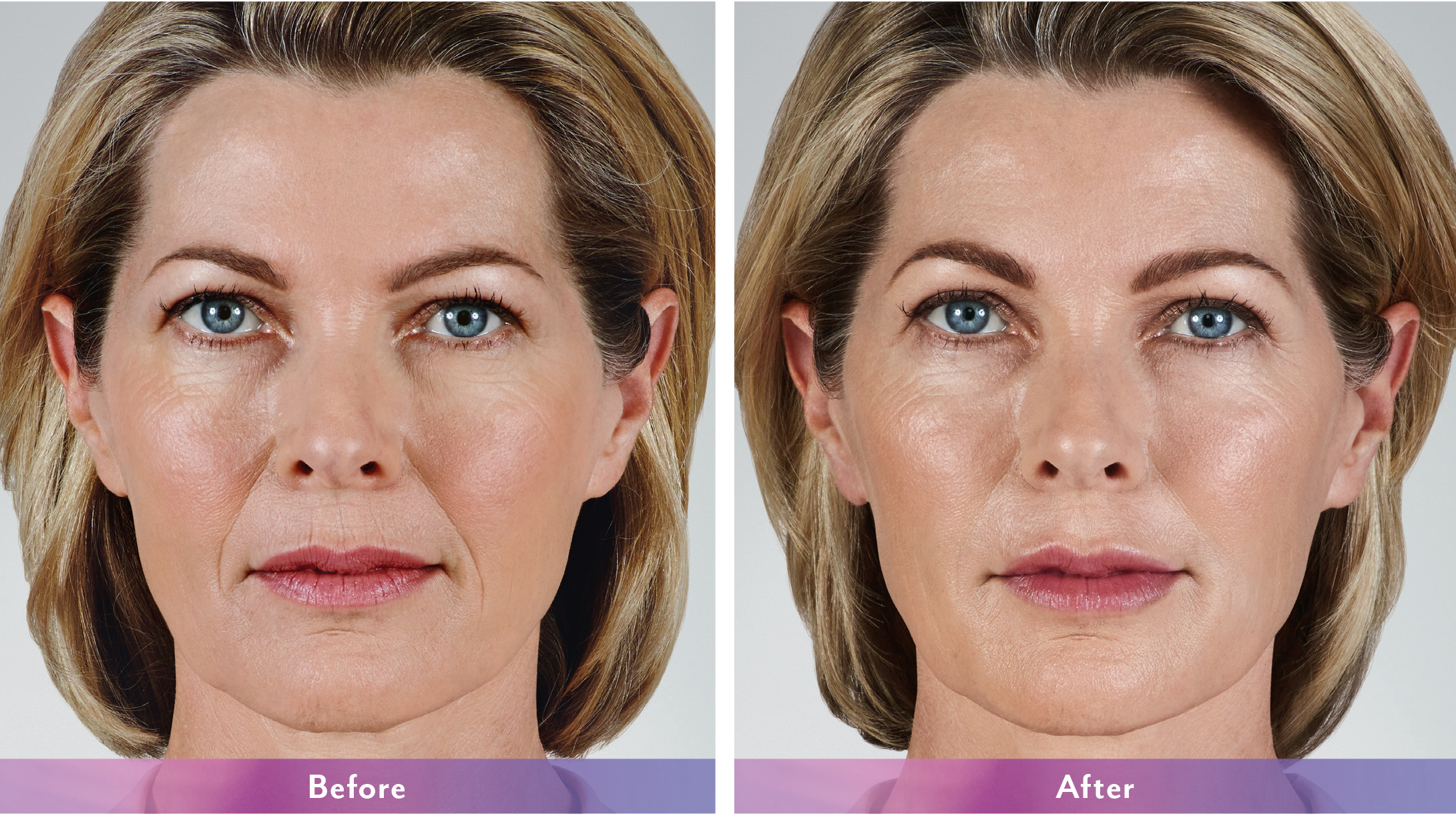 JUVEDERM Before and After Photo
