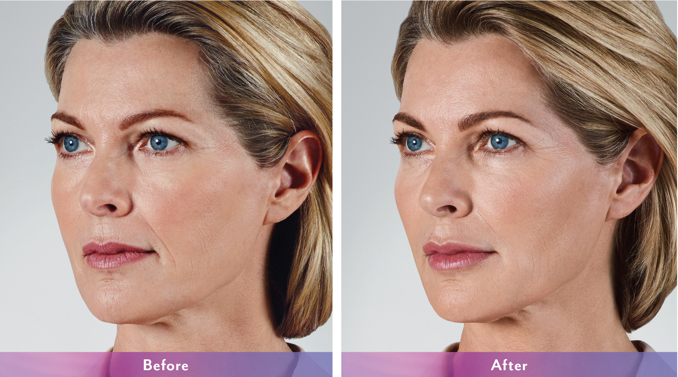 Juvederm