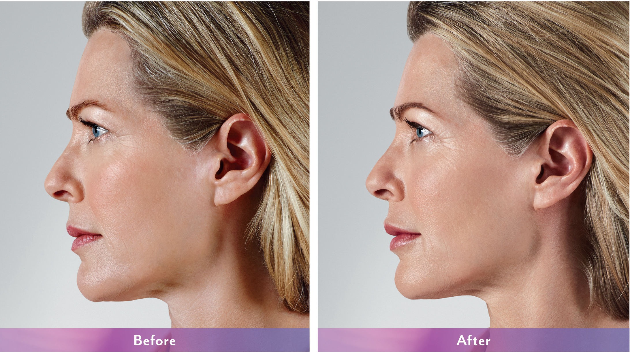 Juvederm Before and After Photo