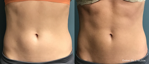 Micro Needling Near Me