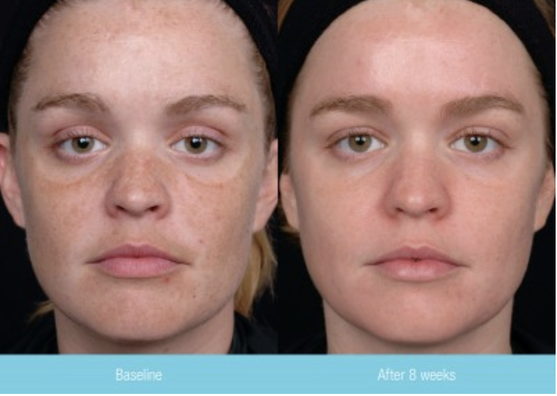 Obagi Blue Peel Radiance